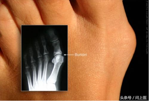 图解8个常见的脚部问题，看看你有没有！
