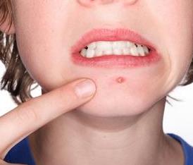 有没有永远不长痘的办法,有没有办法永远不长痘