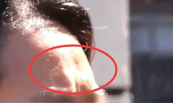 超声刀第二天为什么没有肿,超声刀十天后还是肿