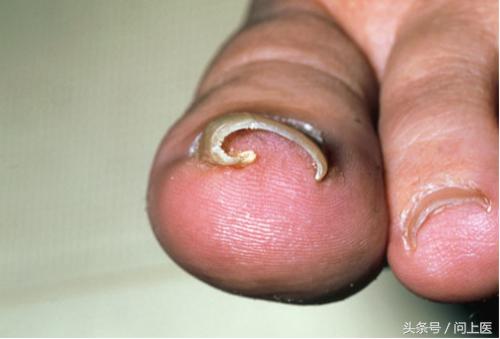 脚气如何根治图片,脚气病治疗好办法