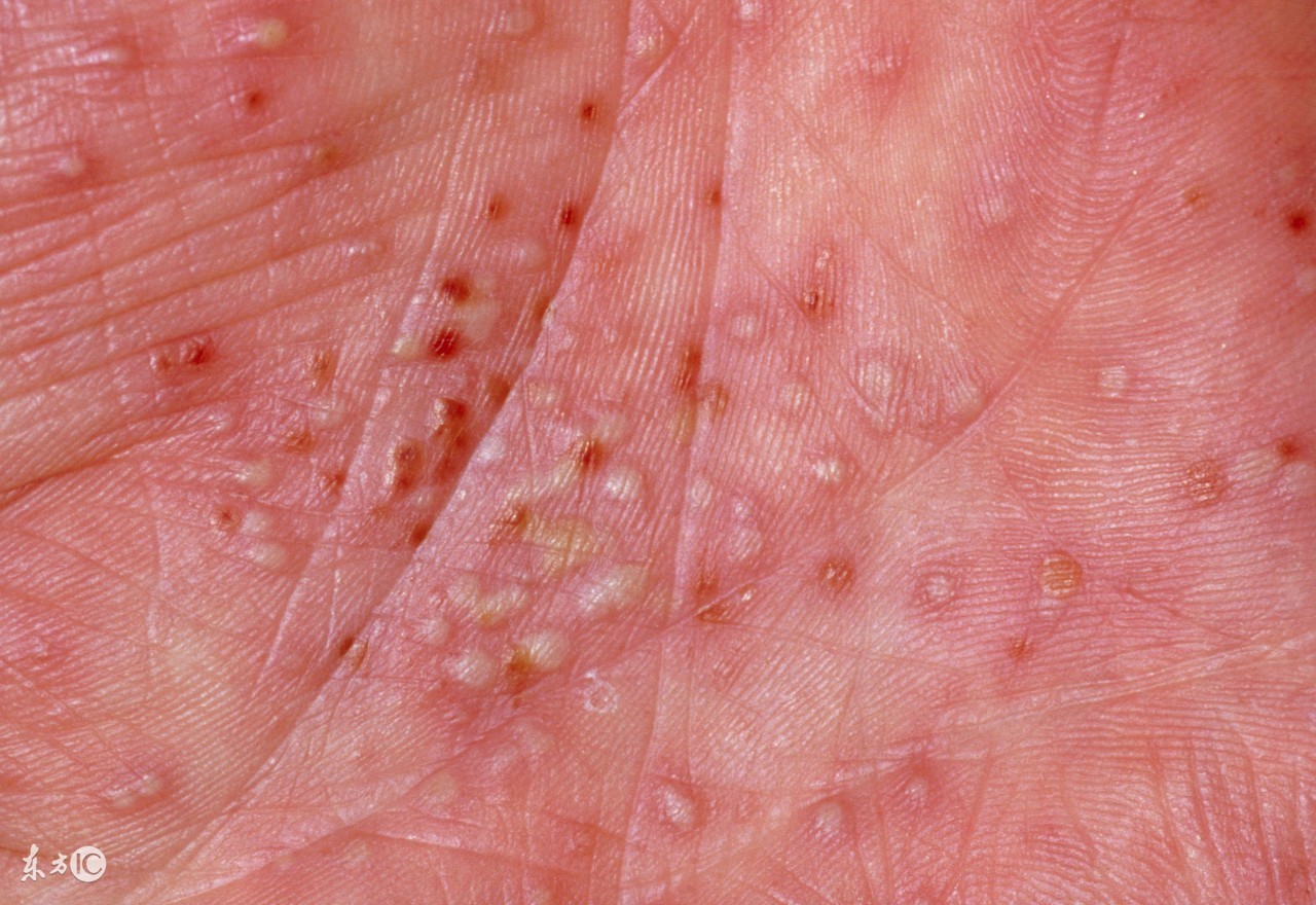 小儿湿疹不可怕育儿专家有妙招,湿疹预防和护理