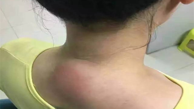 脖子下方有富贵包应注意哪些事项,孩子脖子后面有富贵包是怎么回事