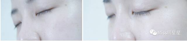 千年黑眼圈解决方案,万年黑眼圈有救的吗