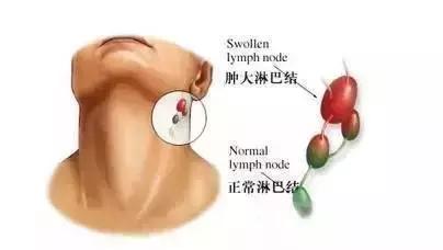 脐周肠系膜淋巴结肿大用药,肠系膜淋巴结肿大饮食怎么吃