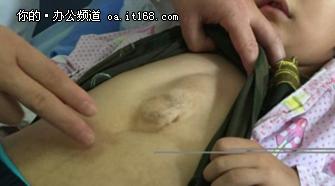 3d打印肿瘤最佳方法,3d打印技术在医学方面成功案例