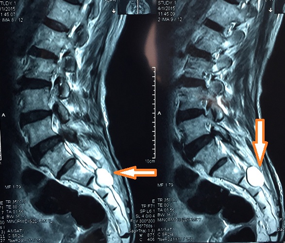 骶管蛛网膜囊肿严重吗,骶管囊肿切除手术步骤