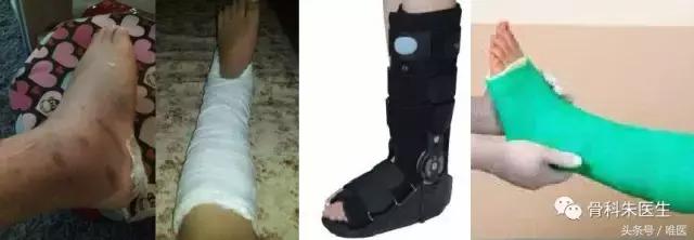 脚踝关节扭伤无骨折怎么恢复快,踝关节扭伤康复治疗注意事项