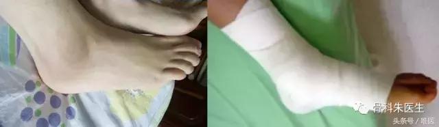 骨科脚踝扭伤怎么快速恢复,医生会怎么处理脚踝扭伤