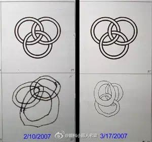 儿童近视眼家长也不用太焦虑,孩子散光几岁治疗最好