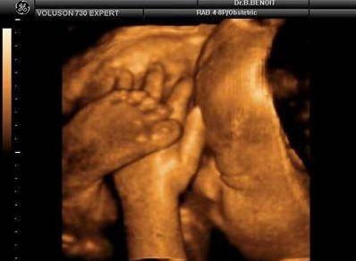 孕期做四维彩超宝宝不配合怎么办,四维产检宝宝不配合怎么办