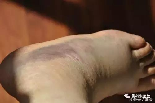 骨科脚踝扭伤怎么快速恢复,医生会怎么处理脚踝扭伤