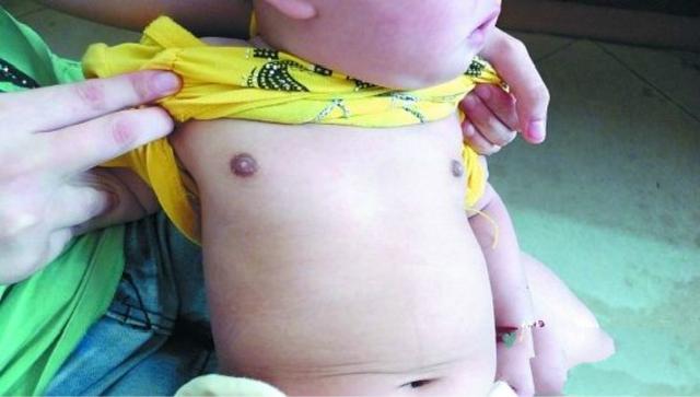 7岁女童被诊断早熟,7岁多女童发现是早熟