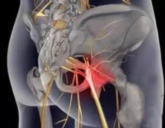 最粗长的针刀治疗女性坐骨神经痛,梨状肌导致的坐骨神经痛怎么治疗