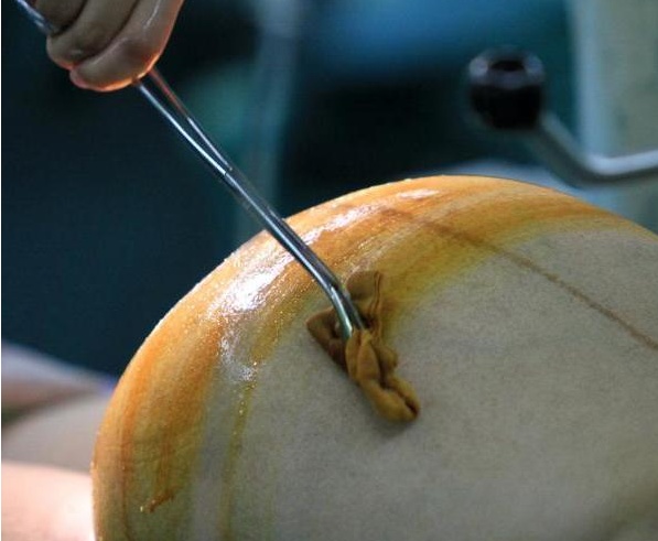 剖腹产的全流程真实记录,顺产剖腹产的十个真相