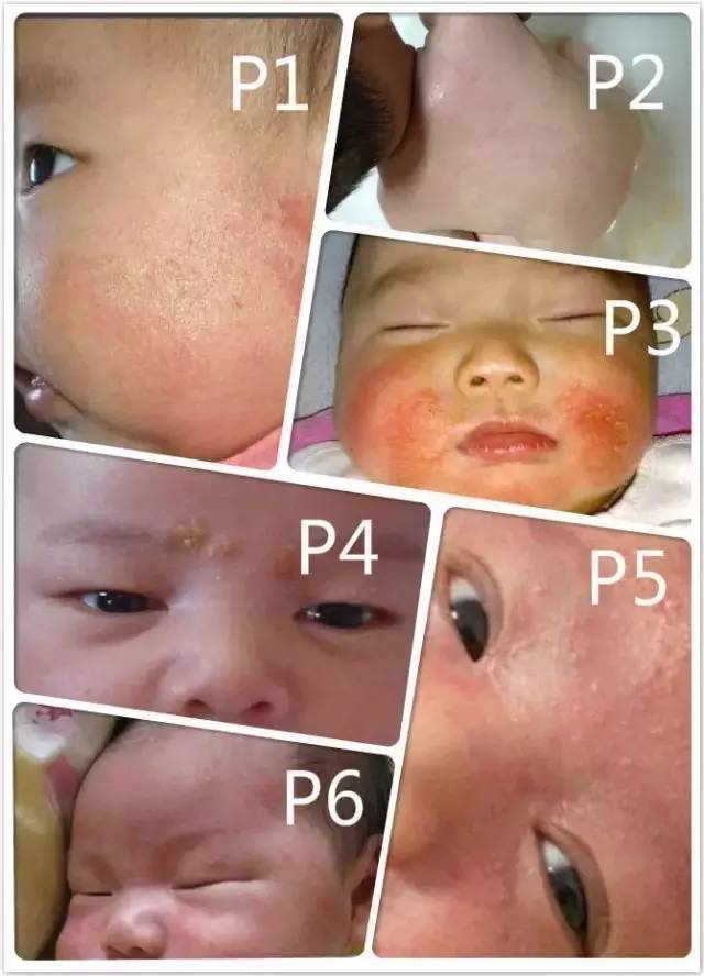 痱子粉可以用在婴儿湿疹上吗 (宝宝湿疹可以涂痱子粉吗)