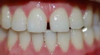 牙缝大漏财有依据吗,牙缝大漏财是谣言吗