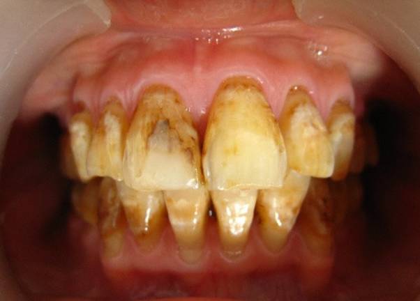 抽烟变丑如果戒了多久可以恢复,吸烟导致严重毁容的图片