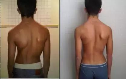 针灸治疗脊柱侧弯的最好方法,脊柱侧弯如何治疗才正确有效