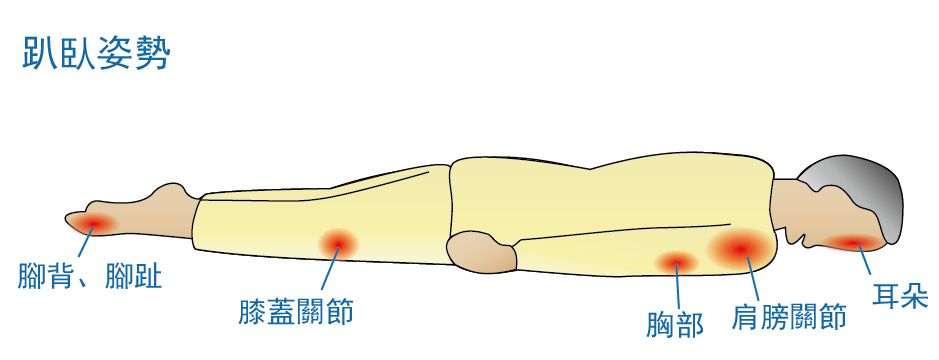 长期卧床怎么会有皮疹,长期卧床患者出现皮肤溃烂