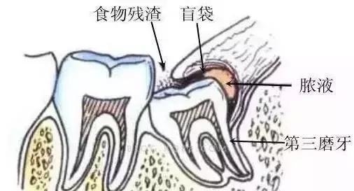 智齿到底要不要拔掉专家告诉你,80%的人智齿都需要拔除