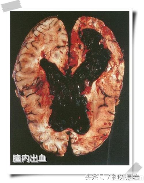 烟雾病脑内出血,烟雾病脑室出血死亡率