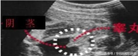生男生女不求人,b超怎么看出胎儿姓名