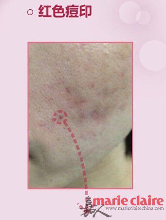 真正的痘印是可以祛的吗,暗紫色痘印是红痘印还是黑痘印