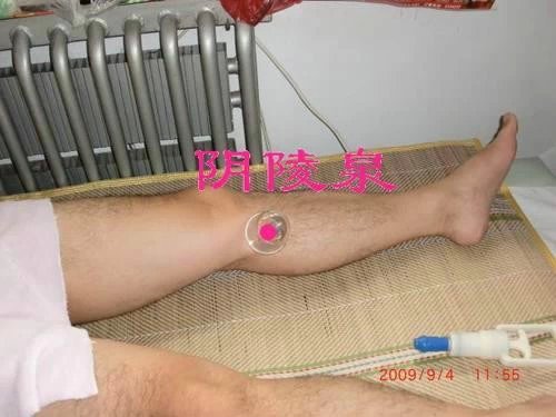 中医治疗疼痛的针灸方法,针灸治疗各种疼痛的穴位