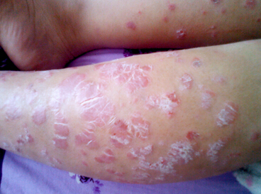 牛皮癣怎么治才能彻底根除牛皮癣,牛皮癣怎么办才能彻底治好