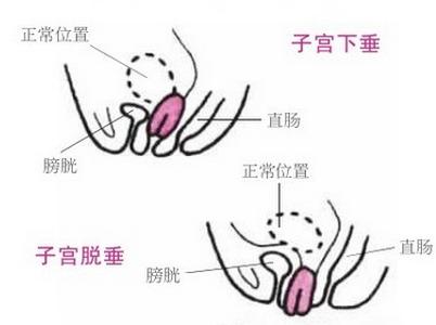 产后必读！常见病防治之子宫脱垂！