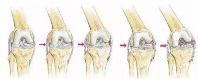 膝关节疼痛的22种疾病,膝关节疼痛警惕四种病35岁