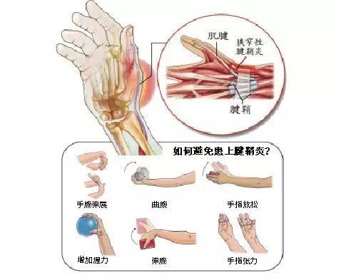 拇指弹响治疗方法,拇指腱鞘炎弹响最快的恢复方法