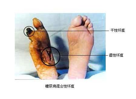 手指盖有竖黑线截肢,手上突然出现凹凸横纹