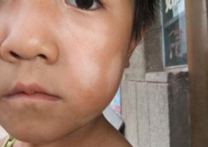 新生儿身上的白斑是怎么回事,新生儿有白斑是怎么回事