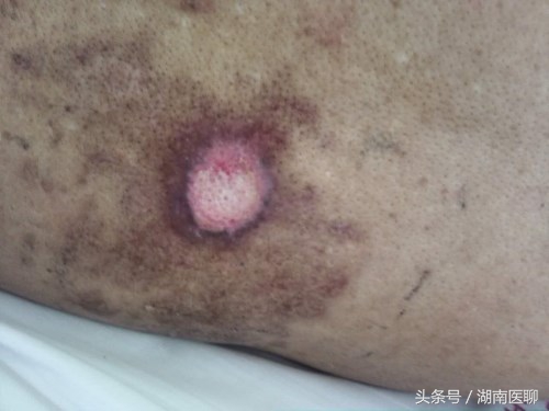 艾灸对治疗带状疱疹有效吗,艾灸治疗带状性疱疹管用吗