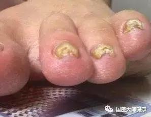 指甲上的月牙预示着什么,指甲上的月牙真的和健康有关系吗