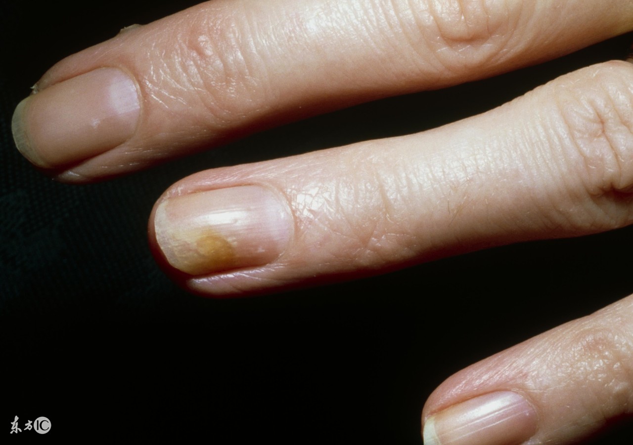 发现有灰指甲的预兆怎么防治,灰指甲是怎么引起的可以治愈吗