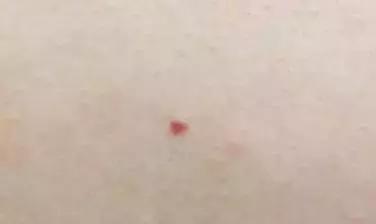 身上长了好多小红痣是怎么回事,出现小红痣不痛不痒