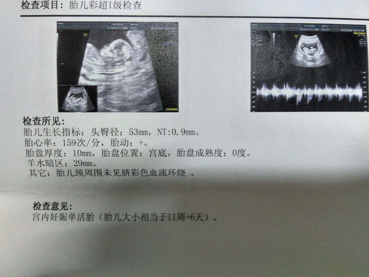 39周顺产的胎宝宝,孕39周想顺产的妈咪注意事项