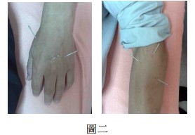 屈指狭窄性腱鞘炎最好的治疗方法,屈指肌腱腱鞘炎示意图