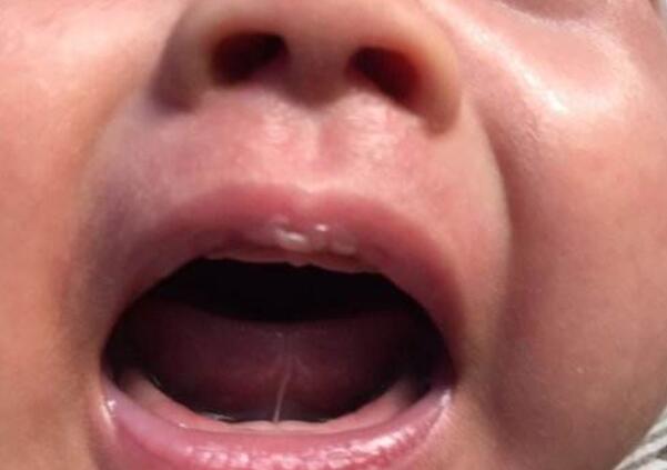 2岁4个月宝宝舌头w型正常吗,1岁宝宝舌头呈w形