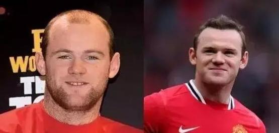 目前关于脱发的最新治疗方法,什么方法治疗脱发效果好