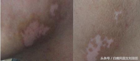 白癜风在治疗过程中白斑变红,身上长了白癜风怎么治疗
