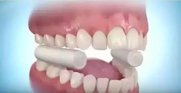 全瓷牙套怎么才算安装好,牙齿矫正有几种牙套图片