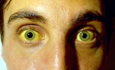 脸色变黑是肝还是肾的问题,脸色变黑一定是肝硬化吗