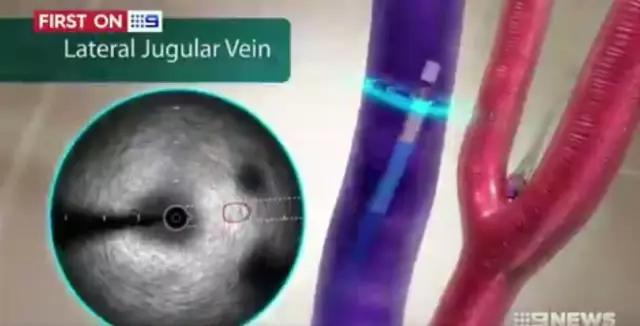 德国高科技治疗高血压,澳洲科学家发明神药