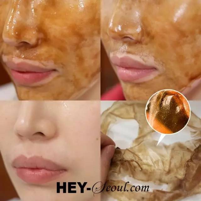 粉刺黑头去除最快方法,鼻子螨虫黑头怎么去除简单方法