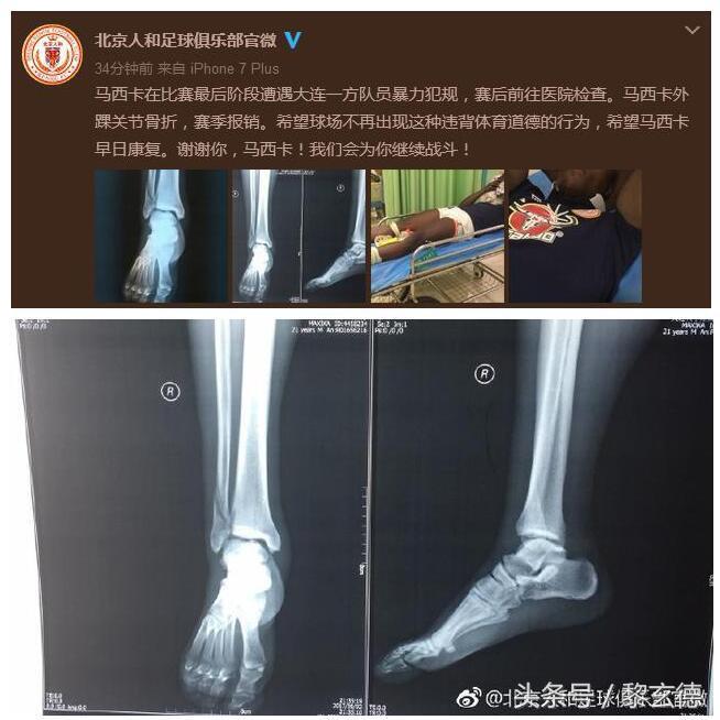 奔袭之王脚踝被铲断赛季报销，这个国家所有外援在中国都半途而废