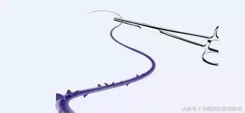 线雕面部提升女的,少女线雕术