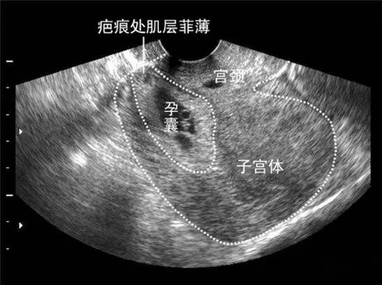 孕期子宫破裂前有什么征兆,怀孕晚期子宫破裂应急预案
